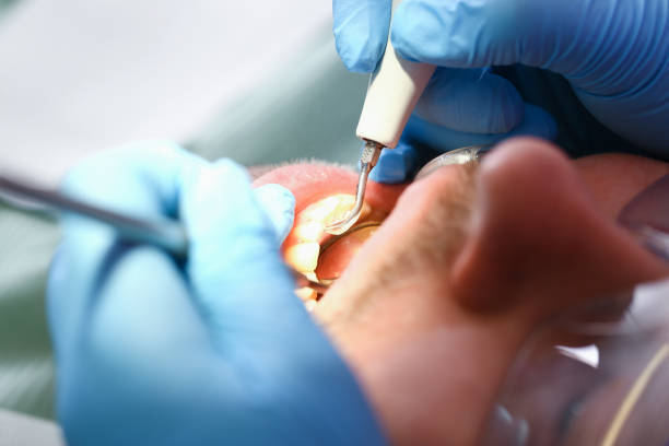 Best Emergency Dentist for Lost Fillings or Crowns in Beaumont, CA