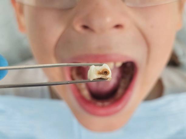 Best Emergency Dental Extractions in Beaumont, CA