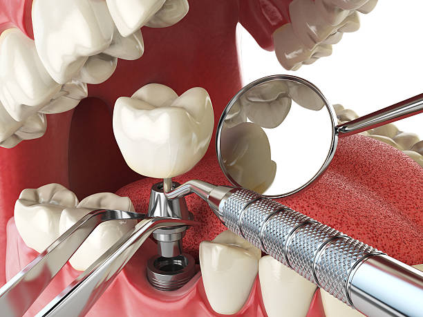Best Emergency Root Canal Treatment in Beaumont, CA